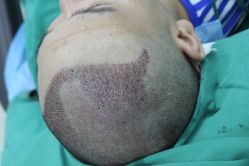 点击看大图 -大麦微针植发丨全国连锁