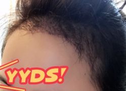 -大麦微针植发丨全国连锁