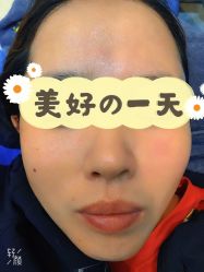 体验后-More摩尔医美の注射线雕光电中心