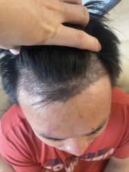 -大麦微针植发丨全国连锁