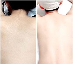 -薇兰专业脱毛连锁机构