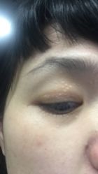 -爱莎扁平疣·汗管瘤·斑痣中心