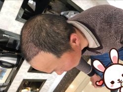 -大麦微针植发丨全国连锁