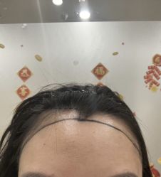 -碧莲盛·不剃发植发