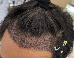 -大麦微针植发全国连锁