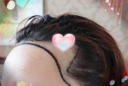 -大麦微针植发全国连锁