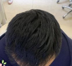 -大麦微针植发丨全国连锁