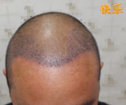 -大麦微针植发丨全国连锁