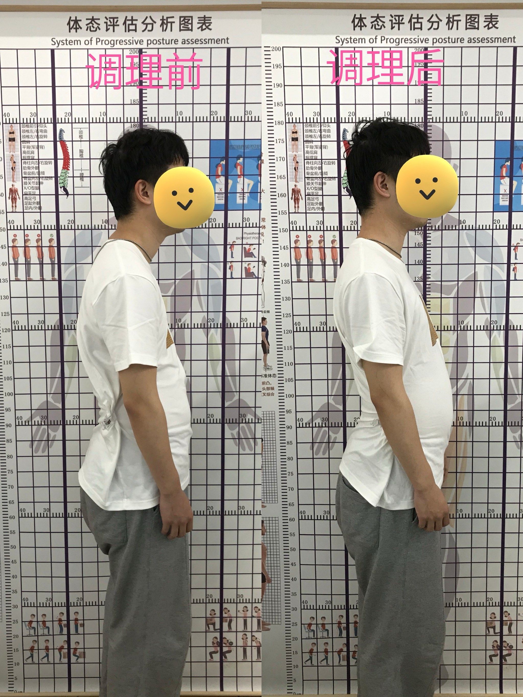 驼背