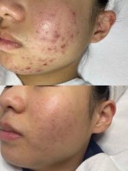 -美肤盾祛痘·问题肌头疗管理中心