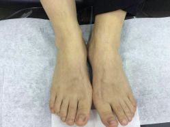 -德哥灰指甲脚气甲沟炎跖疣护理