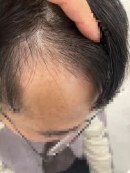 -大麦微针植发全国连锁