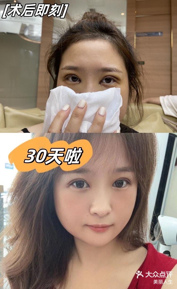 成都素美全切双眼皮一个月术后分享