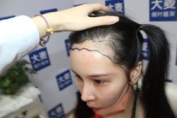 -大麦微针植发丨全国连锁
