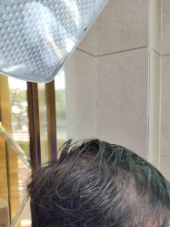 -碧莲盛·不剃发植发