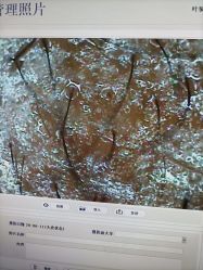 点击看大图 -大麦微针植发丨全国连锁