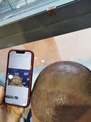 -碧莲盛·不剃发植发