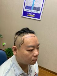 -大麦微针植发全国连锁