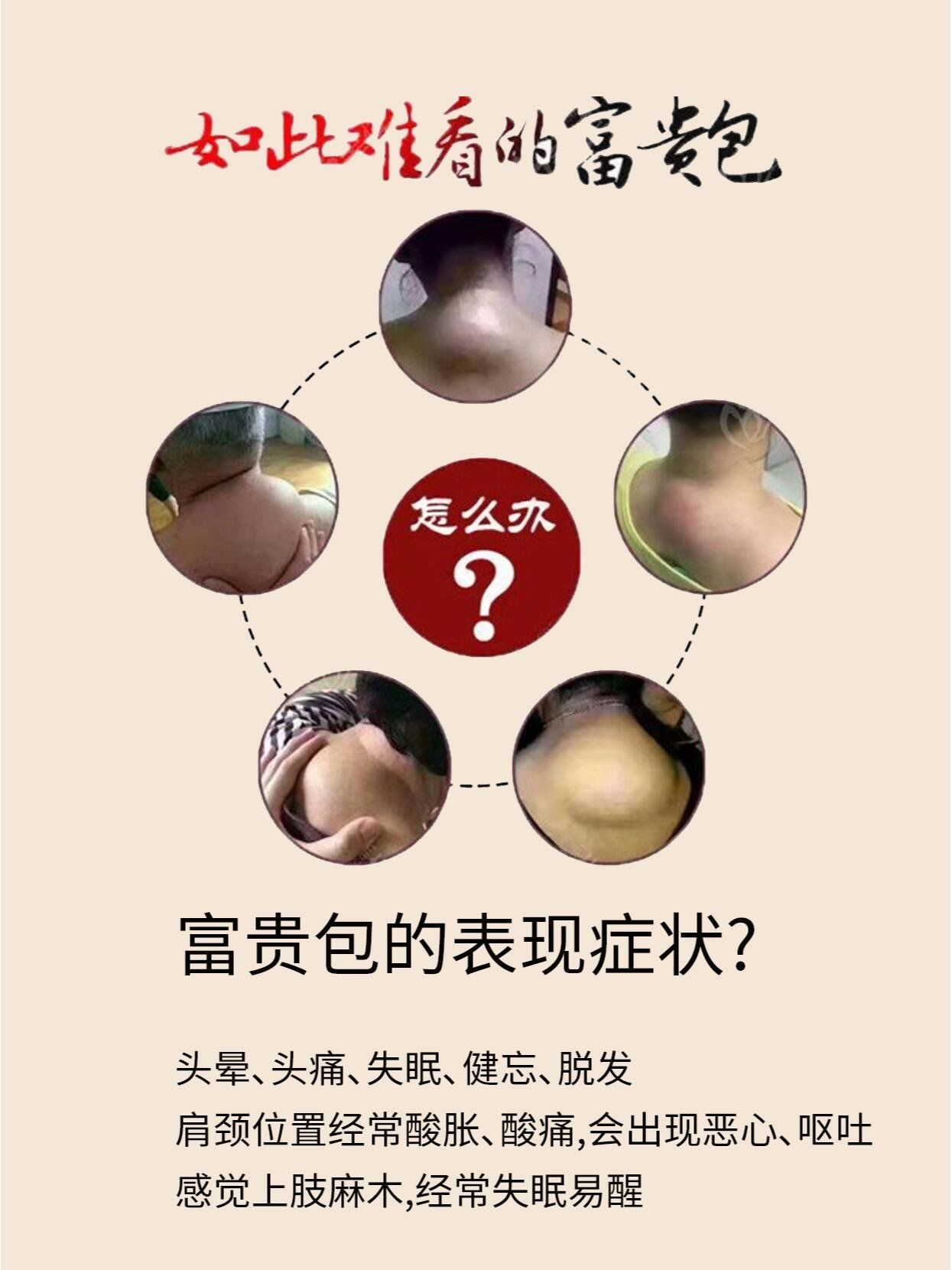 为什么会长富贵包是什么原因为什么在线