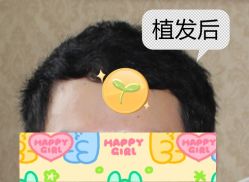 -大麦微针植发全国连锁