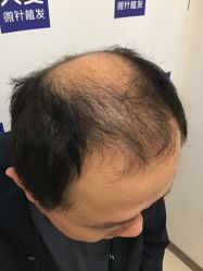 -大麦微针植发丨全国连锁