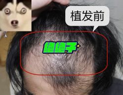 -大麦微针植发全国连锁