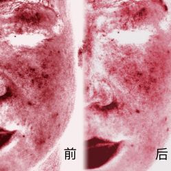 体验前-柠檬一美·Ondapro·轻薄紧致抗衰中心
