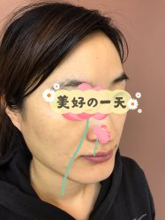 -More摩尔医美の注射线雕光电中心