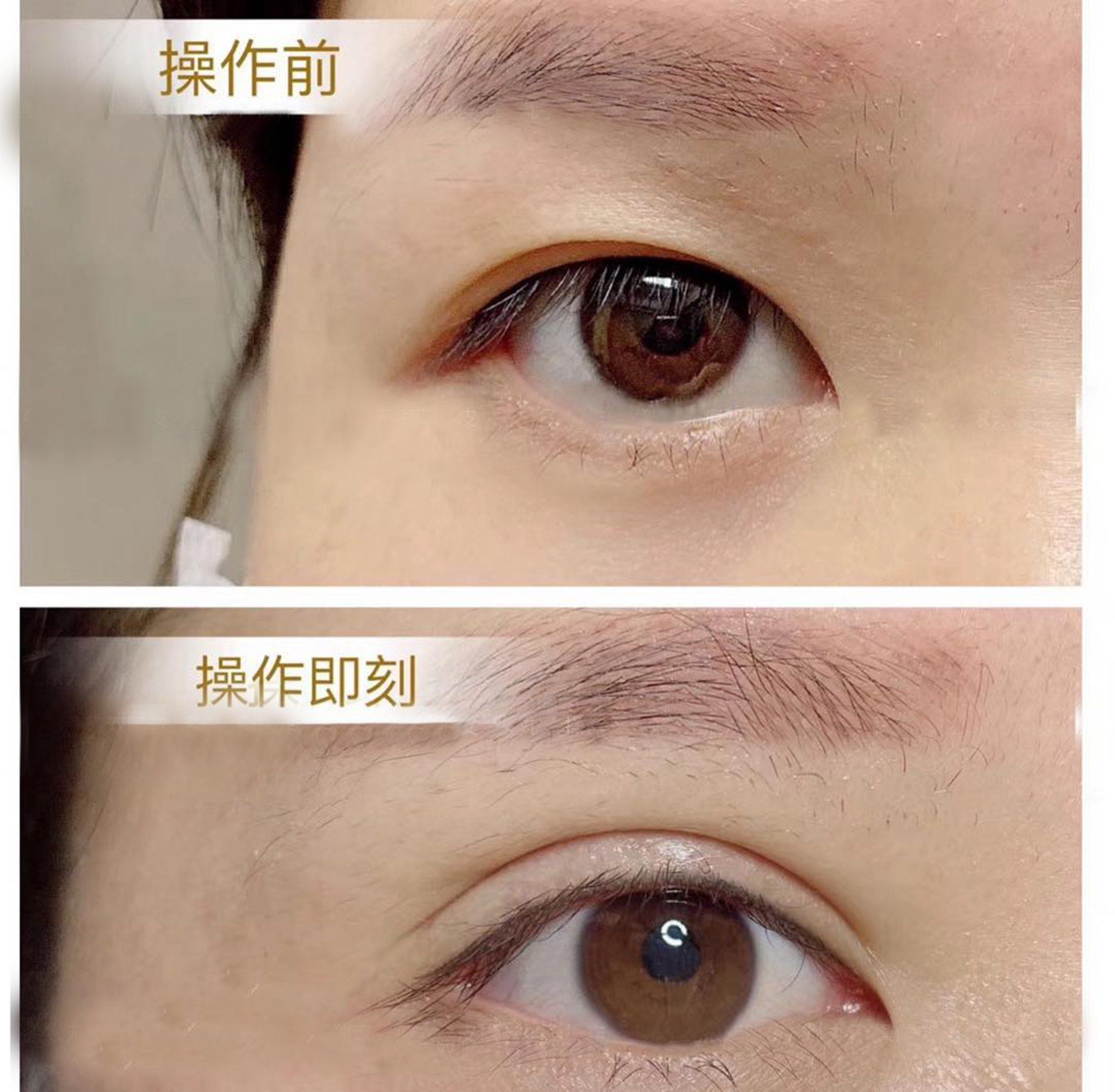28000割的双眼皮还算成功么!