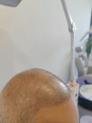 -碧莲盛·不剃发植发