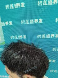 -碧莲盛·不剃发植发