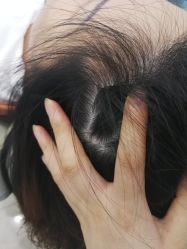 -黑奥秘脱发白发中心