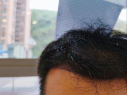 -碧莲盛·不剃发植发