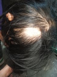 -碧莲盛·不剃发植发