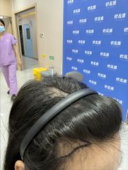 -碧莲盛不剃发植发