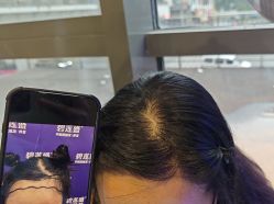 -碧莲盛·不剃发植发