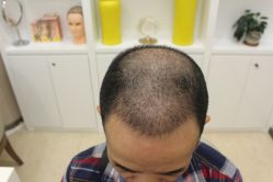 -大麦微针植发丨全国连锁