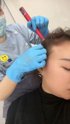 -大麦微针植发全国连锁