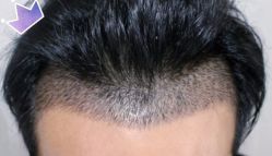 -大麦微针植发丨全国连锁