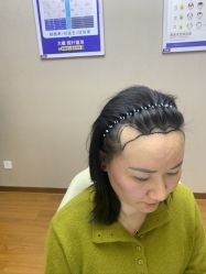 -大麦微针植发全国连锁