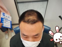 -大麦微针植发丨全国连锁