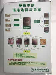 -德哥灰指甲脚气甲沟炎跖疣护理