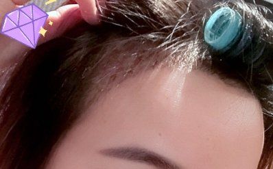 -大麦微针植发丨全国连锁