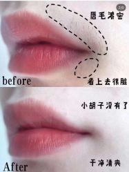 -薇兰专业脱毛连锁机构