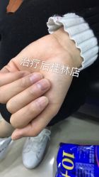 -德哥灰指甲脚气甲沟炎跖疣护理