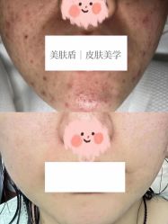 -美肤盾祛痘·问题肌头疗管理中心