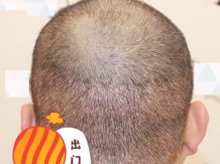 -大麦微针植发全国连锁