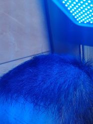 -碧莲盛·不剃发植发