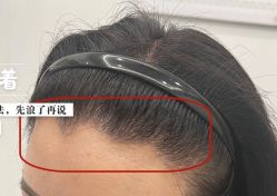 -大麦微针植发全国连锁