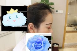 -大麦微针植发丨全国连锁